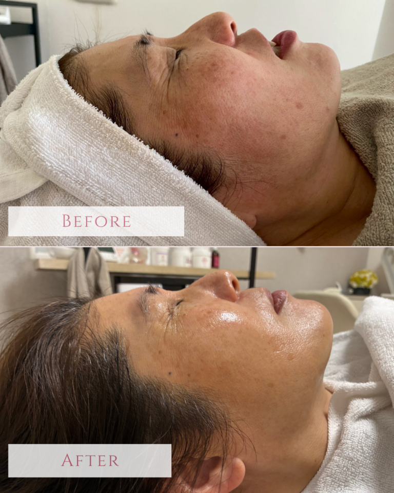 ルネセラムビフォーアフター